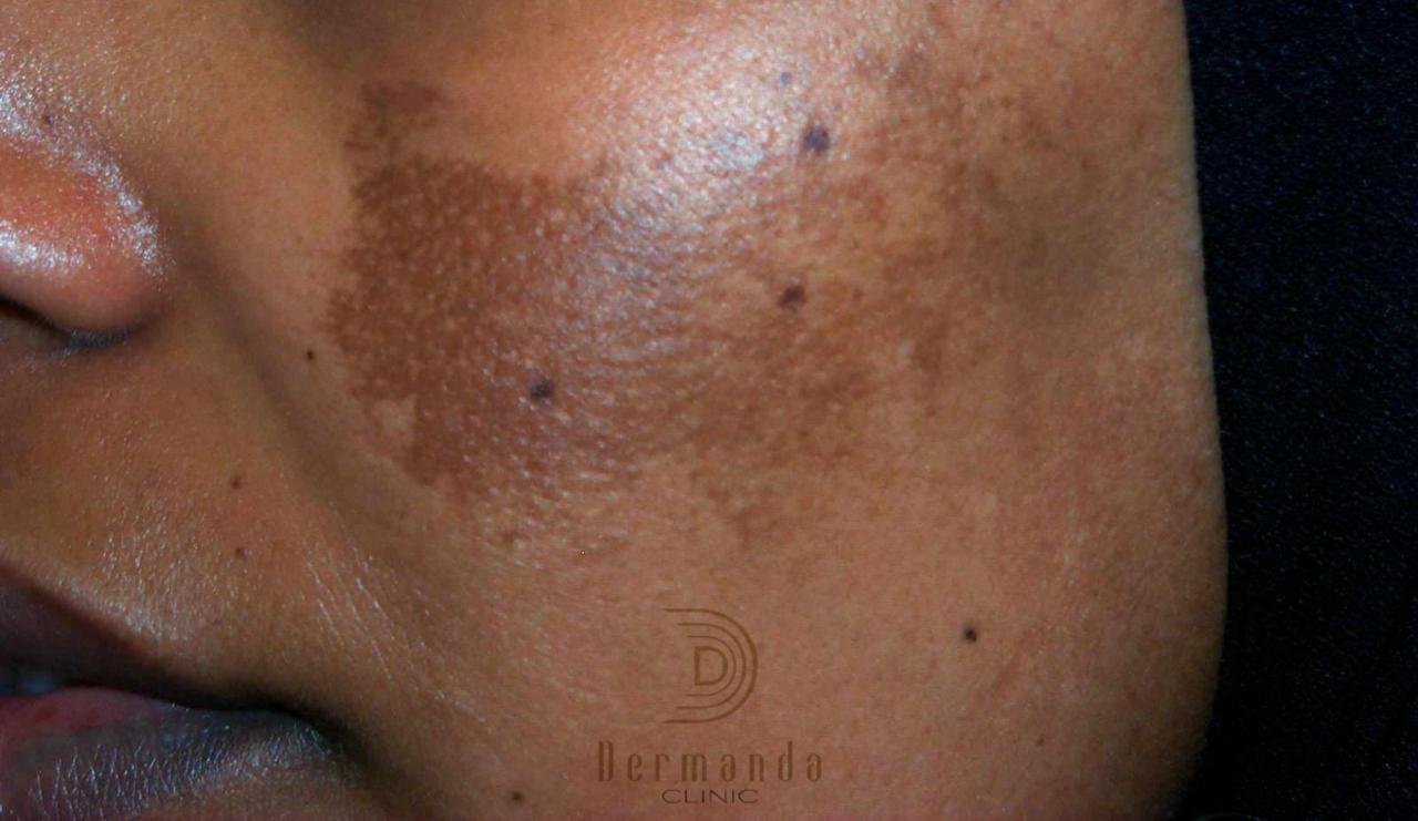 صورة مميزة: ‏Dermanda Clinic إسم رائد في علاج الكلف بمختلف أنواعه