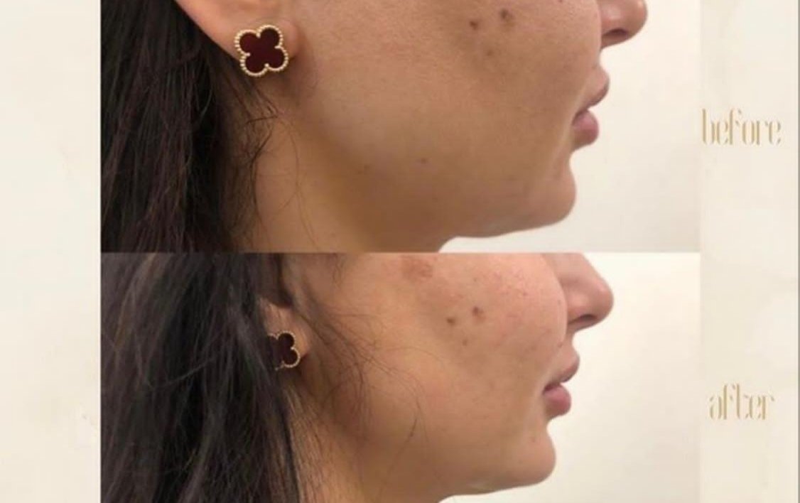 مركز Dermanda Clinic يقدم HIFU - صورة مميزة صورة مميزة: مركز Dermanda Clinic يقدم HIFU
