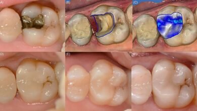 بين الماضي والحاضر الدكتور حبيب ظريفه يوضح عن آلية استخدام تقنية CAD/CAM Technology في طب الأسنان