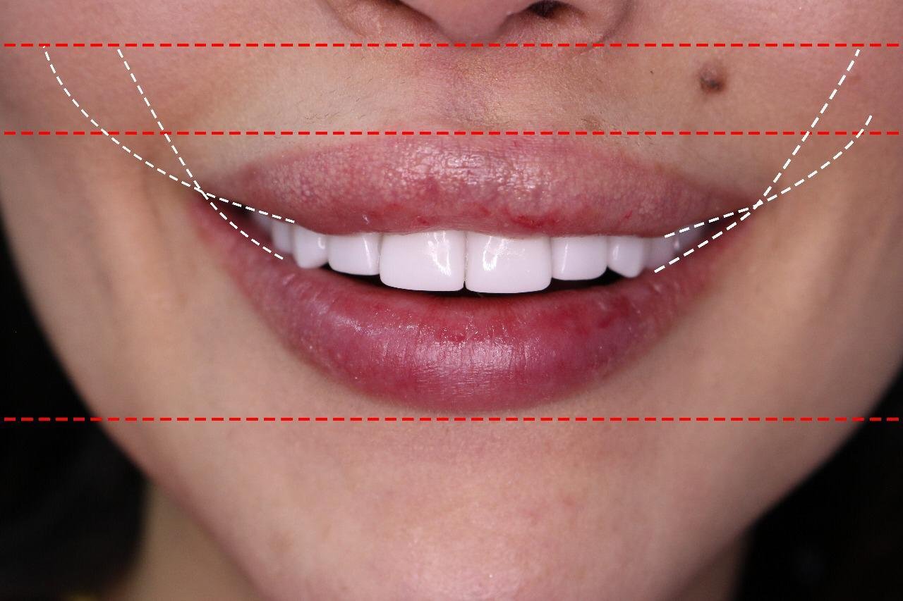 صورة مميزة: الدكتور Habib Zarifeh يبتكر تقنية جديدة لمحاربة الشيخوخة و تجميل الأسنان Smile Lift