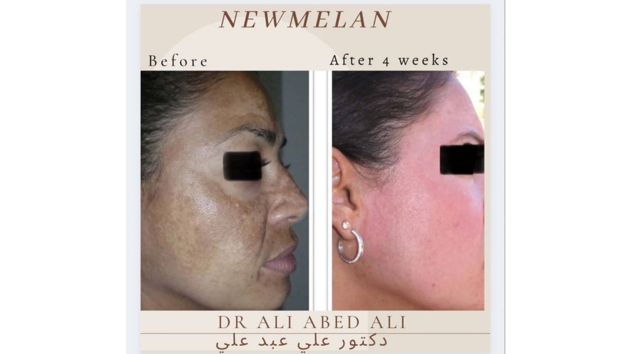 دكتور التجميل ali abedali يتحدث عن تقنية newmelan pigmentation - صورة مميزة صورة مميزة: دكتور التجميل ali abedali يتحدث عن تقنية newmelan pigmentation