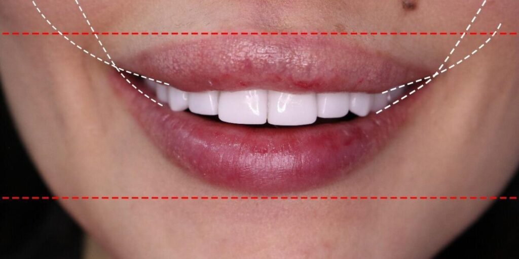 الدكتور Habib Zarifeh يبتكر تقنية جديدة لمحاربة الشيخوخة و تجميل الأسنان Smile Lift