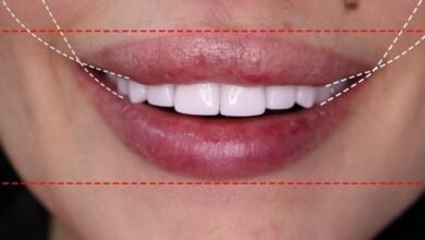 الدكتور Habib Zarifeh يبتكر تقنية جديدة لمحاربة الشيخوخة و تجميل الأسنان Smile Lift