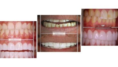 الدكتور Habib Zarifeh يقدم نصائح حول اختيار درجة اللون الأبيض Bleach المناسب لأسنان المريض