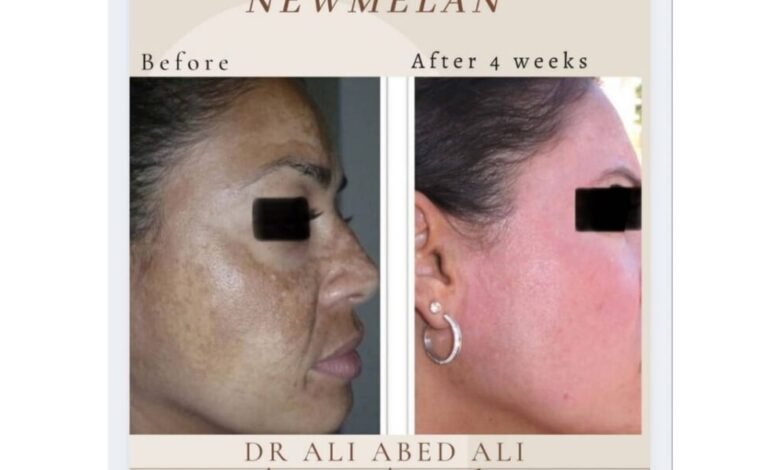دكتور التجميل ali abedali يتحدث عن تقنية newmelan pigmentation