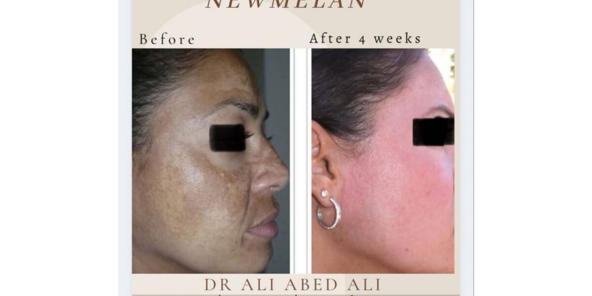 دكتور التجميل ali abedali يتحدث عن تقنية newmelan pigmentation - صورة مميزة صورة مميزة: دكتور التجميل ali abedali يتحدث عن تقنية newmelan pigmentation