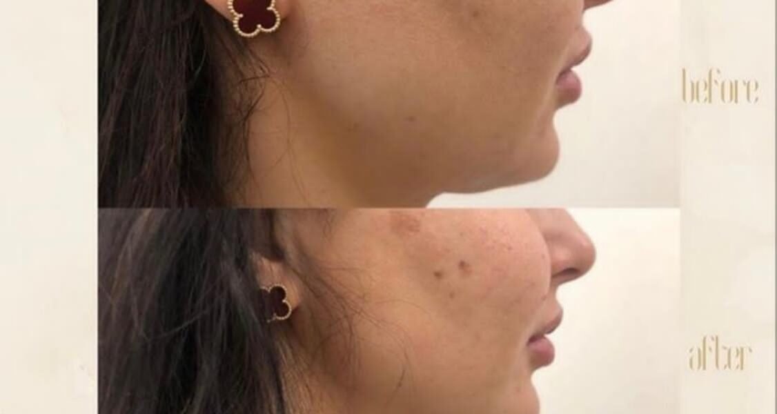 مركز Dermanda Clinic يقدم HIFU - صورة مميزة صورة مميزة: مركز Dermanda Clinic يقدم HIFU